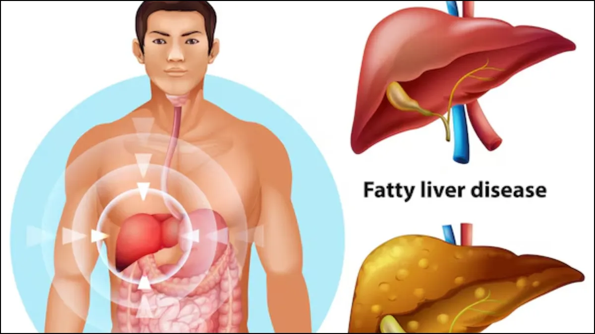 फैटी लिवर में लिवर के अंदर जमा चर्बी को दिखाने वाला मेडिकल चित्र