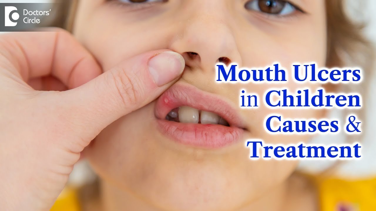 child mouth ulcers causes and treatment